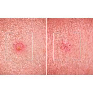 Men Expert Derma Control S.O.S Solución Anti-Imperfecciones 45 Ml