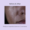 Isdinceutics Salicylic Renewal, 30 ml. - Isdin