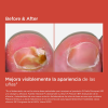 SI-NAILS® MicoXpert MD, 4.5 ml. - Isdin