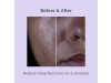 Isdinceutics Salicylic Renewal, 30 ml. - Isdin