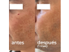 Cofre Despigmentante Gel Crema Clear Azelaic, 30ml + Gel Clear Skin R, 30ml. - Segle Clinical 
