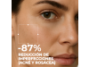 Set Tratamiento Anti-imperfecciones y Rojeces. - Segle Clinical
