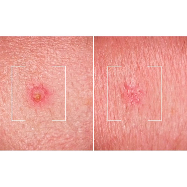 Men Expert Derma Control S.O.S Solución Anti-Imperfecciones 45 Ml