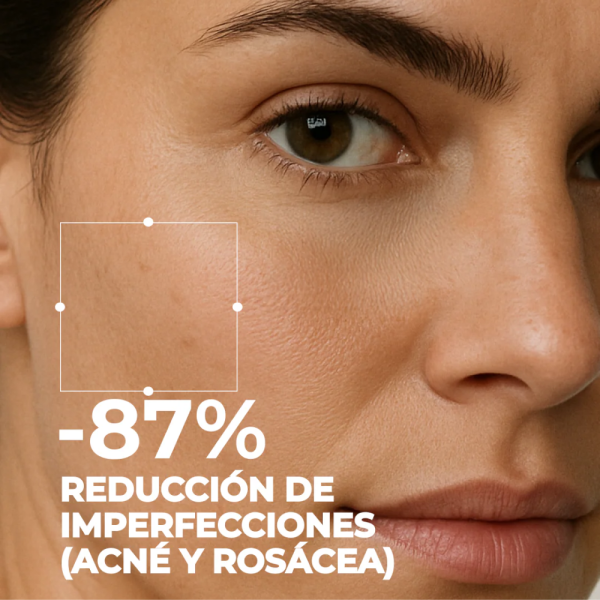 Set Tratamiento Anti-imperfecciones y Rojeces. -Segle Clinical