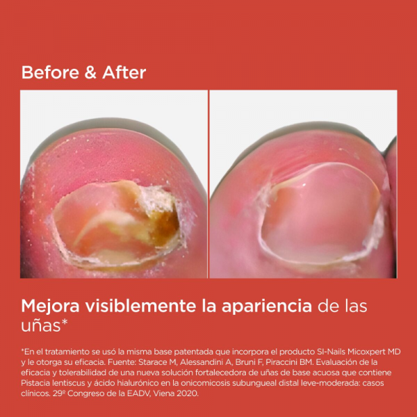 SI-NAILS® MicoXpert MD, 4.5 ml. - Isdin
