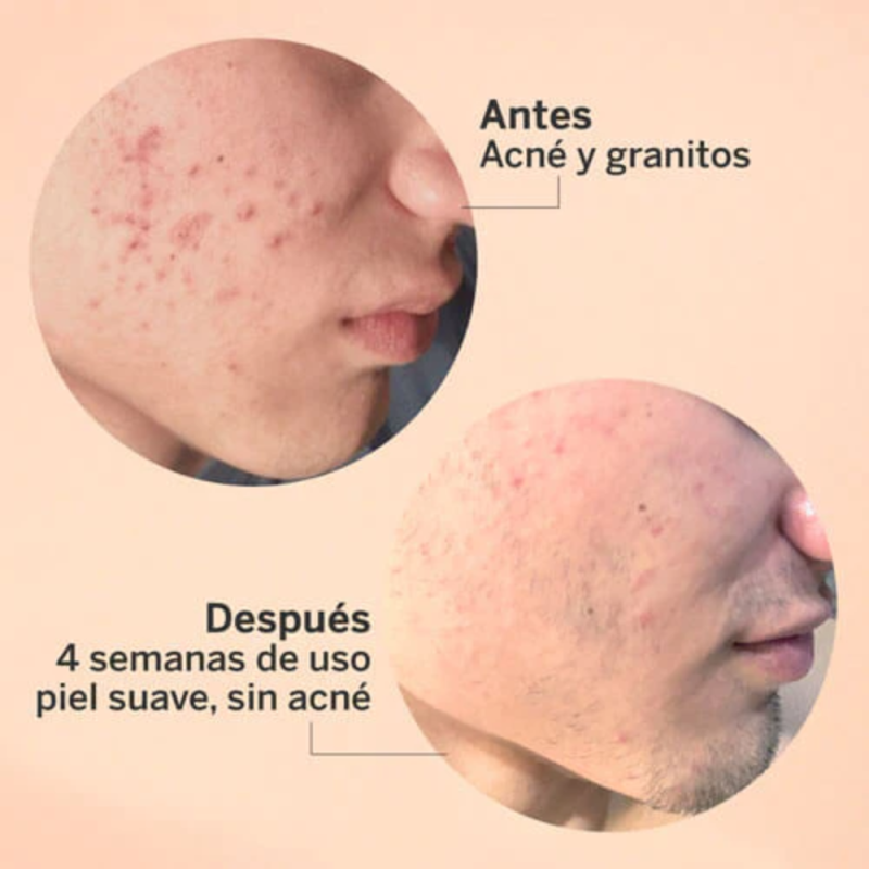 Exfoliante AHA/BHA, 30 ml. - Segle Clinical