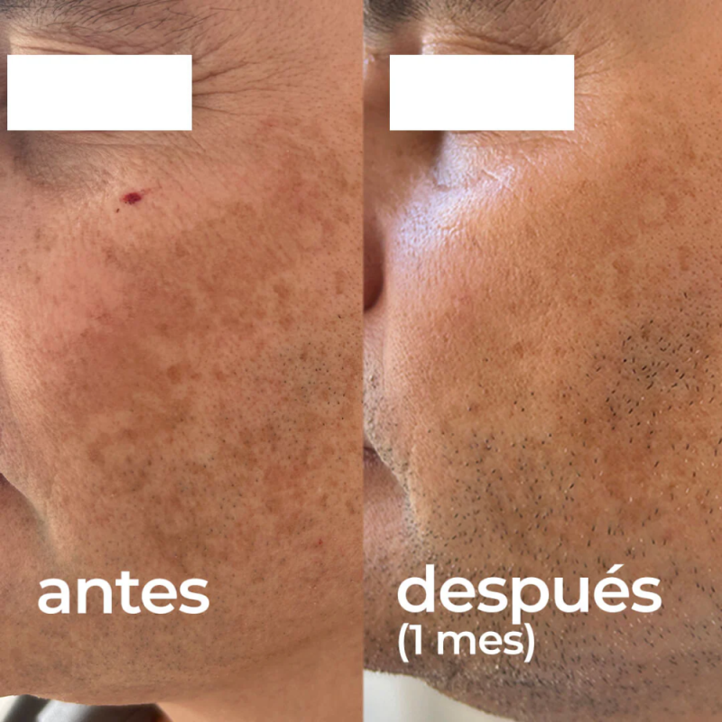 Cofre Despigmentante Gel Crema Clear Azelaic, 30ml + Gel Clear Skin R, 30ml. - Segle Clinical 